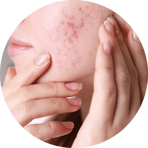 Acne Scarring