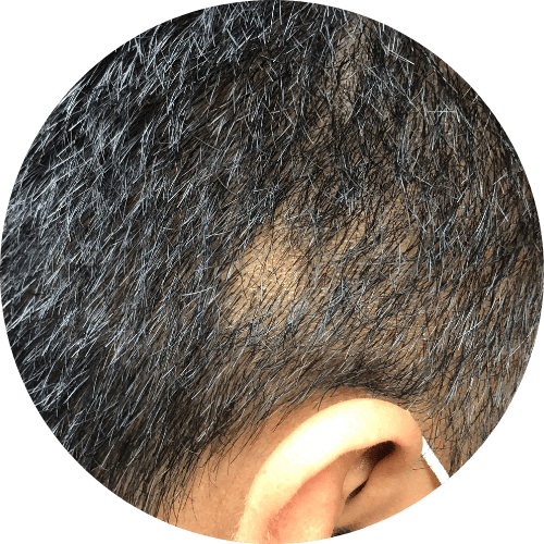 Alopecia Areata