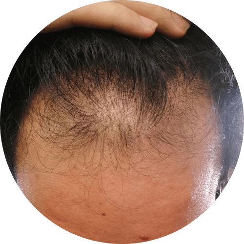 Androgenetic Alopecia