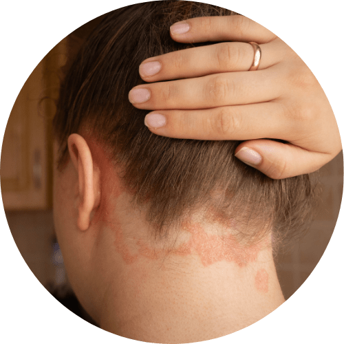 Psoriasis